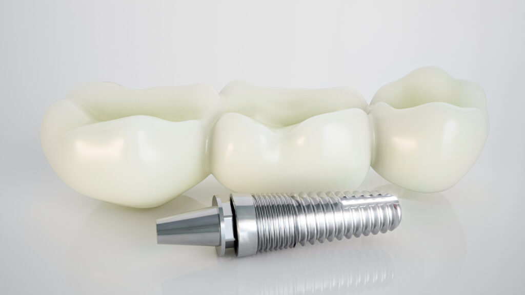 brooklyn dental implants